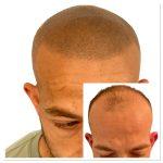 Scalp Micro Pigmentation results by Taylors Hairdressing