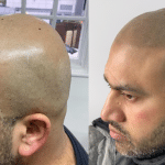 Scalp micropigmentation - before and after man