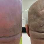 Before and after male scalp micropigmentation - Essex
