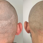 Male scalp micropigmentation Southend rayleigh essex