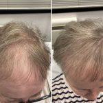 Scalp Micro Pigmentation in Essex