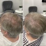 Scalp Micro Pigmentation results