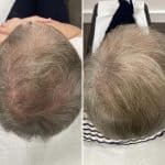 Scalp Micro Pigmentation before and after